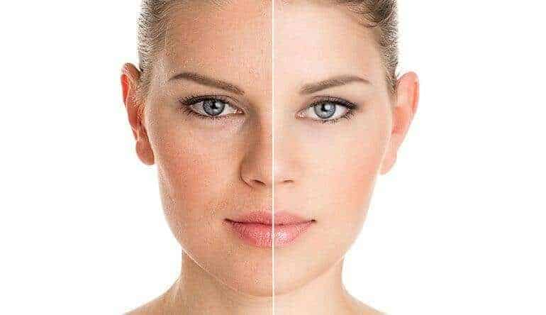 what can stop you from undergoing facelift surgery?